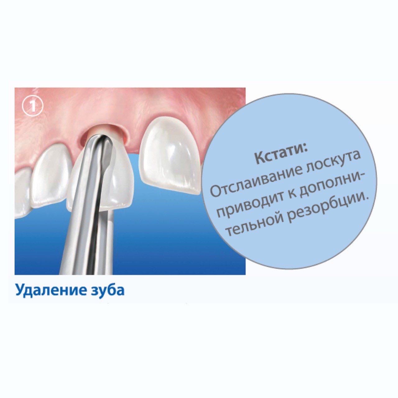 Методика сохранения альвеолярного гребня